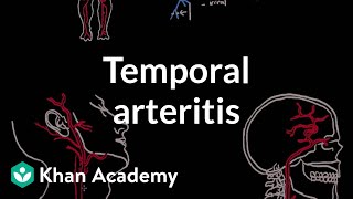 Takayasu arteritis  Circulatory System and Disease  NCLEXRN  Khan Academy [upl. by Llennoc]