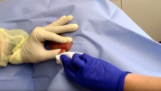 Abscess Drainage Performed by Dermatologist Dr David Myers [upl. by Lane366]