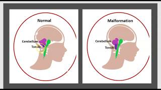 La Syringomyélie Malformation dArdnold Chiari LHydrocéphalie Maladie du Filum Syrinx Traitement 3m [upl. by Kellyann11]