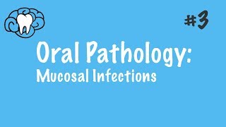 Oral Pathology  Mucosal Infections  INBDE ADAT [upl. by Pietrek363]