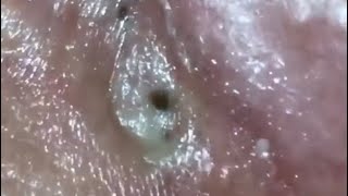 Popping Big Blackheads 😱 [upl. by Nylemaj]