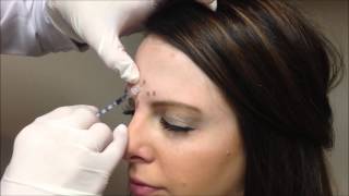 Allergan Botox Injections [upl. by Petulia]