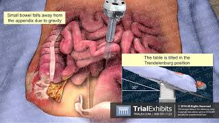 Laparoscopic Appendectomy [upl. by Kadner644]