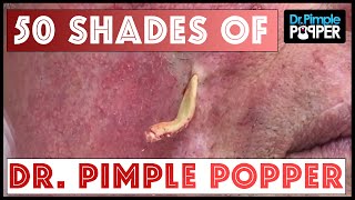 50 shades of DrPimplePopper A 1 Million Subs Special [upl. by Quintina300]