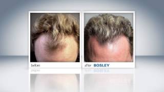 Bosley Hair Restoration Patient Review  Bill S [upl. by Arutak980]