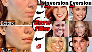 Botox Lip Flip Before and Afters  Everything you NEED to Know [upl. by Esilehs]