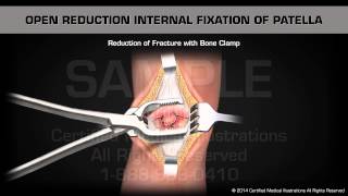 Open Reduction Internal Fixation of Patella [upl. by Prouty]