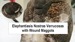 Elephantiasis Nostras Verrucosas and Wound Maggots [upl. by Yvette]