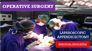 Laparoscopic vs Open Surgery Recovery [upl. by Noelopan]