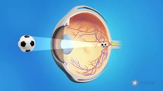 What are cataracts [upl. by Nnylamme]