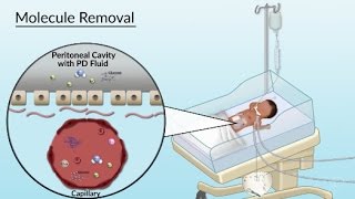 Peritoneal Dialysis by S Su A Olszewski  OPENPediatrics [upl. by Notlehs372]