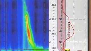 esophageal manometry [upl. by Jamin32]