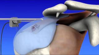 Shoulder Arthroscopy [upl. by Martella]