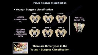 The Impact of Vertebral Compression Fractures [upl. by Catrina]