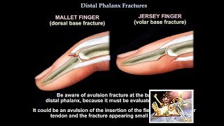 Distal Phalanx Fractures  Everything You Need To Know  Dr Nabil Ebraheim [upl. by Plerre]