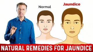 Hemolytic hepatic and obstructive Jaundice explained [upl. by Alleciram393]