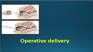 OPERATIVE DELIVERY  Instrumental deliveries Vacuum amp Forceps [upl. by Keviv]