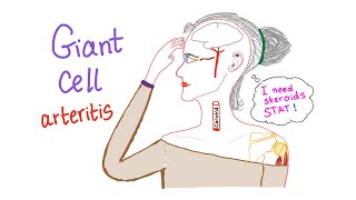 Giant cell arteritis Temporal arteritis [upl. by Yderf253]