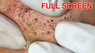 Blackheads removal  Best Pimple Popping Videos [upl. by Bashuk]