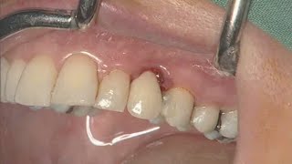 Dr Mok Reviews the New Natrelle Gummy Bear Implants [upl. by Devlen]