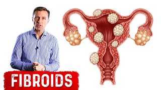 Ayurvedic Treatment for Multiple Fibroids  Swami Ramdev [upl. by Wurst939]