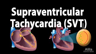 Supraventricular Tachycardia SVT PSVT Animation [upl. by Lizbeth]