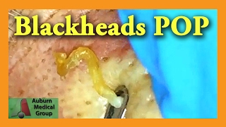 Blackheads POP  Auburn Medical Group [upl. by Routh]