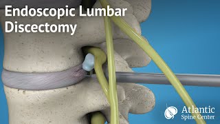 Endoscopic Lumbar Discectomy [upl. by Aihsekyw]