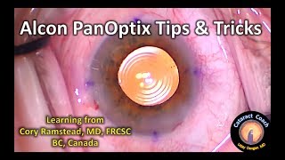 Alcon PanOptix Trifocal IOL Tips amp Tricks for Cataract Surgery [upl. by Aicnetroh]