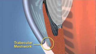 Closed Angle Glaucoma [upl. by Lolita]