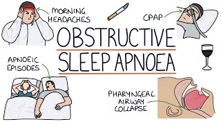 Obstructive Sleep Apnoea [upl. by Suiratnauq]