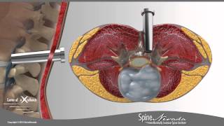 Lumbar Microdiscectomy  Spine Center Northern Nevada Northern California  Spine Surgery [upl. by Shuping]