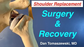 Innovative Treatment for Shoulder Arthroplasty  Dr McFarland [upl. by Maharva]