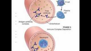 Systemic Lupus Erythrematosus SLE [upl. by Anassor]