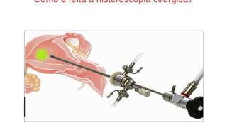 Histeroscopia cirúrgica [upl. by Ramhaj235]
