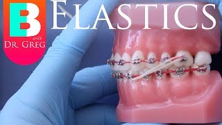 BRACES EXPLAINED Elastics  Rubber Bands [upl. by Lazor]