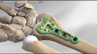 Distal Radius Fracture Repair  Volar Plate [upl. by Almund]