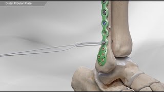 Distal Fibular Plate [upl. by Park]