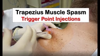 Trapezius Muscle Spasm Trigger Point Injection [upl. by Akilam814]