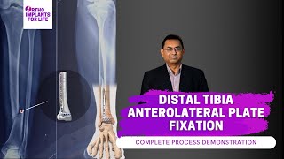 Distal Tibia Anterolateral Locking Plate Fixation Procedure [upl. by Mona497]