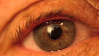 myasthenia gravis ocular clinical tests [upl. by Sidhu]