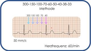 EKGBefundung Herzfrequenz in Sekunden bestimmen 300150100Methode [upl. by Eseekram885]