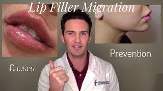 Lip Filler Migration Causes amp Prevention [upl. by Nilhsa590]