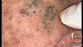 Dr Pop  Deep Blackheads in old Skin removing amp treatment 2020 Part 4 HD [upl. by Eisso]