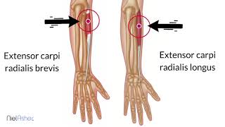 Trigger Point Tutorial  Wrist Extensor Muscles [upl. by Valene494]