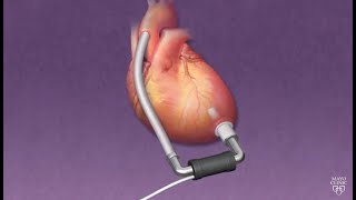 Mayo Clinic Minute How ventricular assist devices can help heart patients [upl. by Ecile]