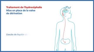 Hydrocéphalie  valve de dérivation peritonéale [upl. by Lorna]