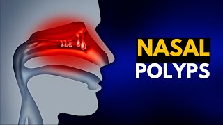 NASAL POLYPS Causes SIgns and Symptoms Diagnosis and Treatment [upl. by Nohsar829]