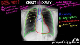 LEARN to Read a Chest Xray in 5 minutes [upl. by Filia]