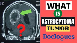 What is Astrocytoma Tumor [upl. by Joed]